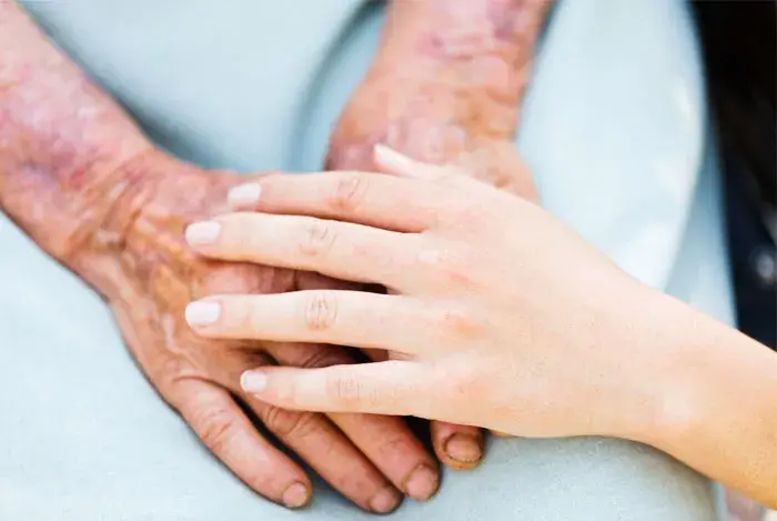 alzheimers